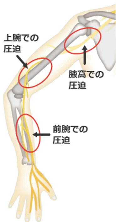 橈骨神経麻痺(ハネムーン症候群)朝起きたら手が動かない