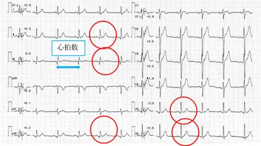 心筋梗塞の検査~正常異常心電図でなにが分かる~–医療法人社団倫生会みどり病院