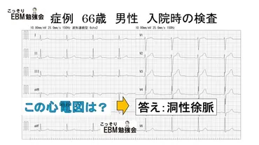 分かる!洞性徐脈の心電図
