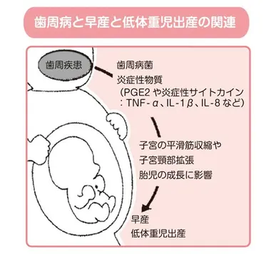 妊娠期における歯周病のリスク 