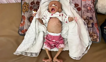国連は、ガザで子供の栄養不良が増加していることを指摘
