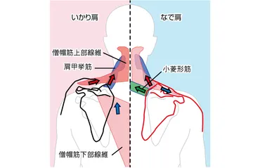 いかり肩となで肩の肩こり解消 